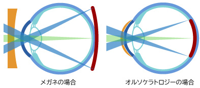 オルソケラトロジーの近視抑制効果の仕組み図